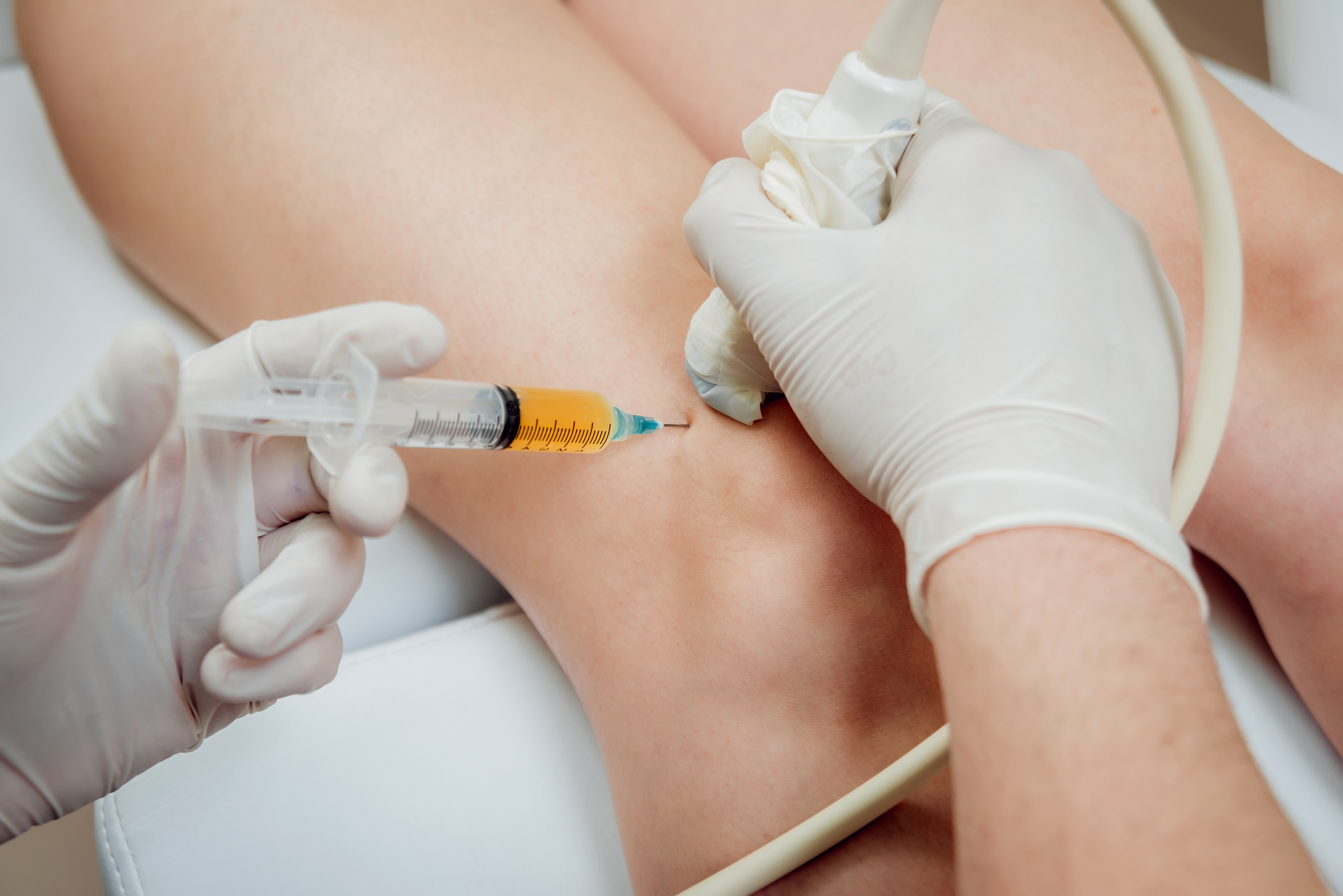 Ultrasound-guided platelet-rich plasma injection of the knee