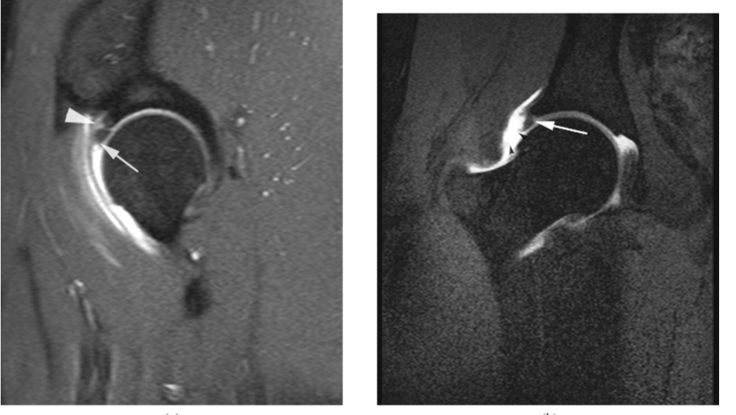 Hip labral tear visualized on MRI at the arrows