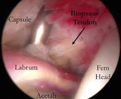 IP Tendon