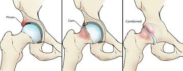 Impingement Syndrome